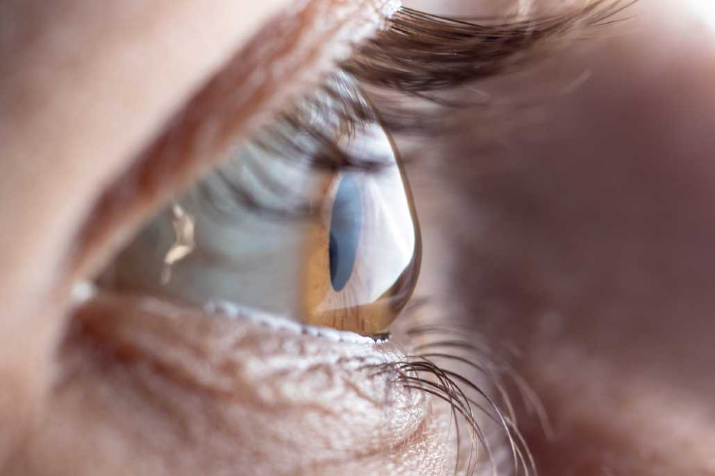 Astigmatism: Symptoms, Tests & Treatment