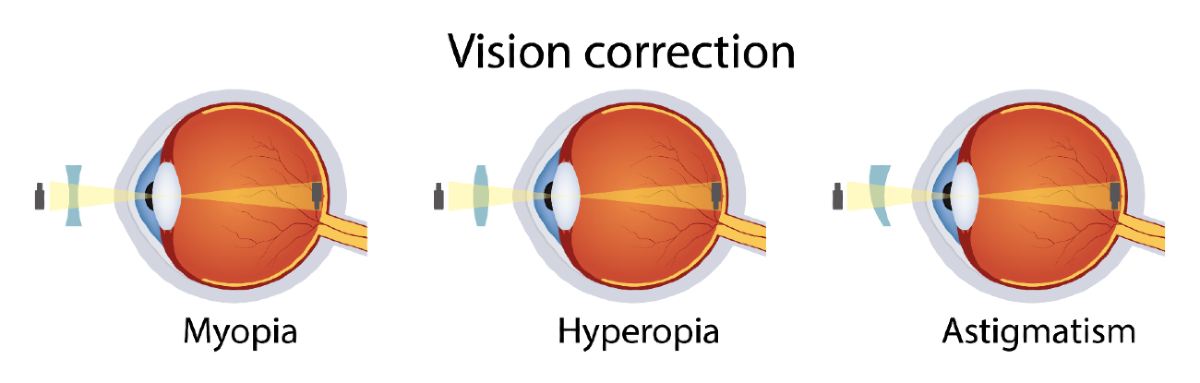 myopia vs astigmatism vs hyperopia