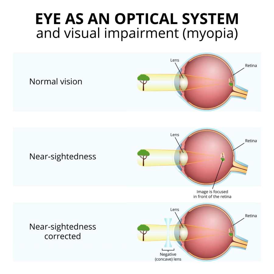 Myopia and normal vision. Myopia is being shortsighted. Illustrated diagram.