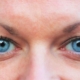 two blue eyes after lasik